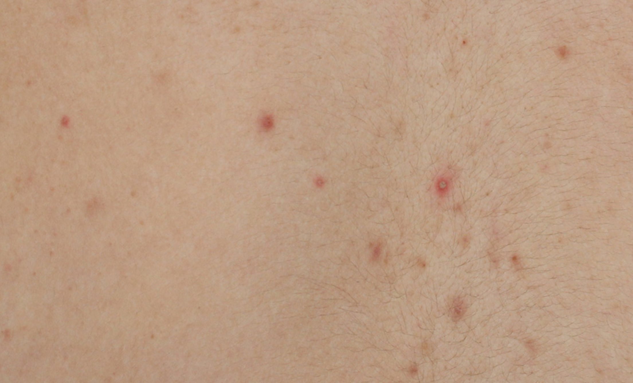 A picture of blemishes on a skin before using Eucerin DERMOPURE CLINICAL Correcting Body Cream