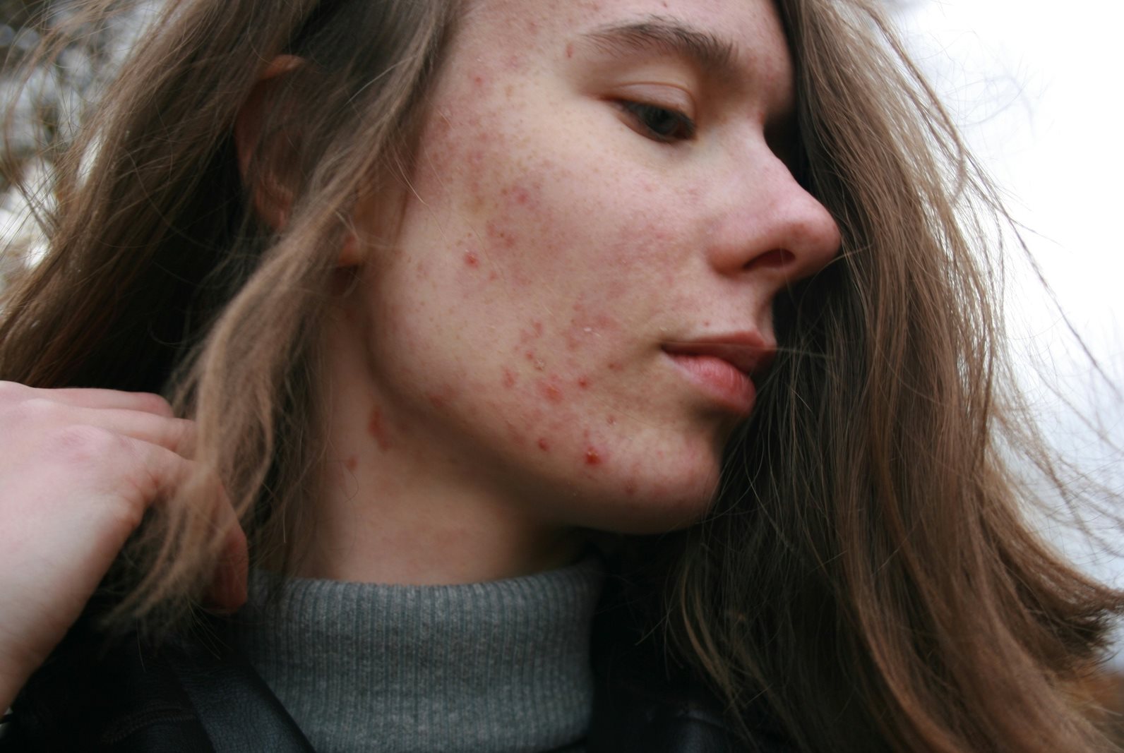 A woman with blemishes on the face