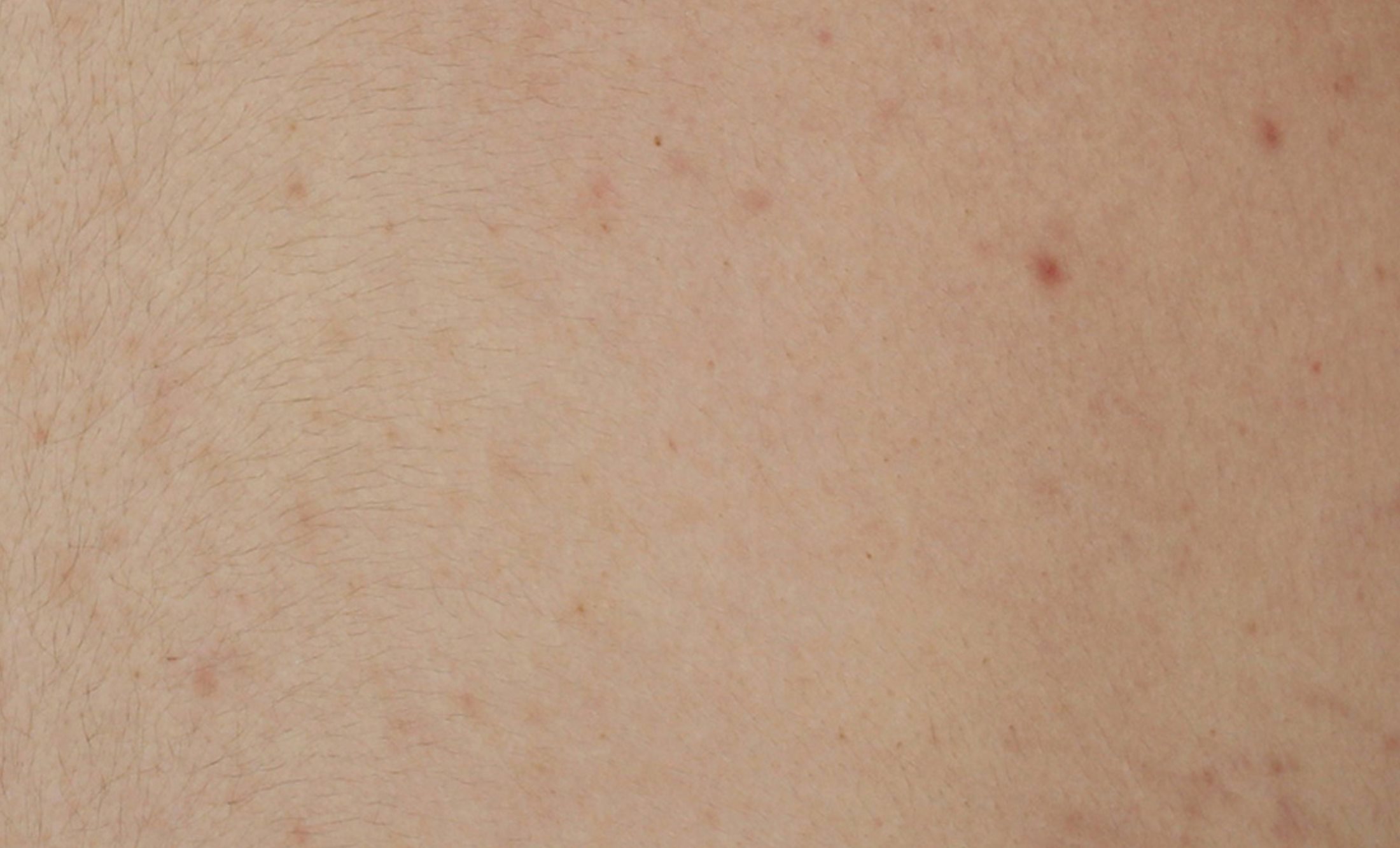 A picture of clean skin and reduced appearance of acne prone skin after using Eucerin DERMOPURE CLINICAL Correcting Body Cream