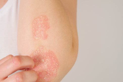 Psoriasis sur le coude et l'avant-bras