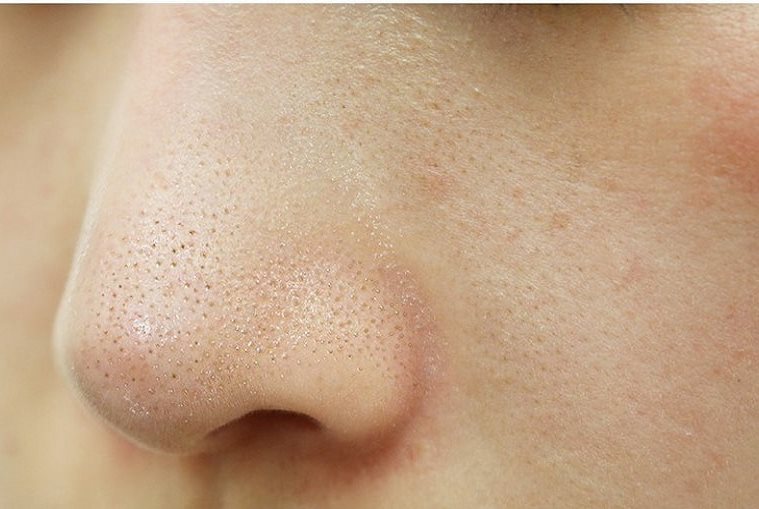 Cách trị mụn cám