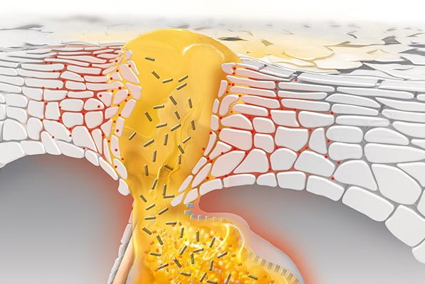 Ursache von Pickeln und Mitessern